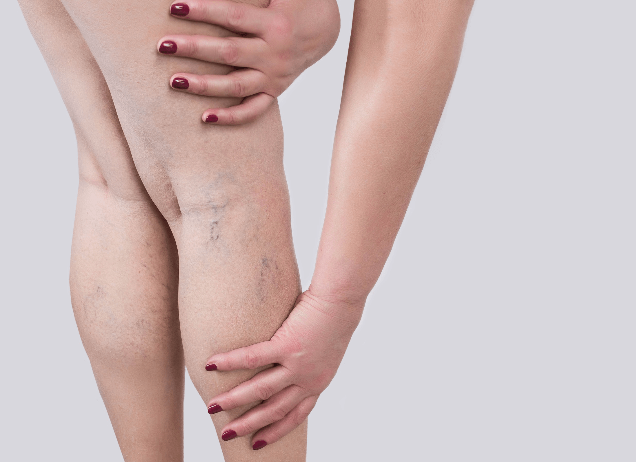Spider Veins Vs Varicose Veins Treatment Whats the Difference  Blog   South Valley Vascular