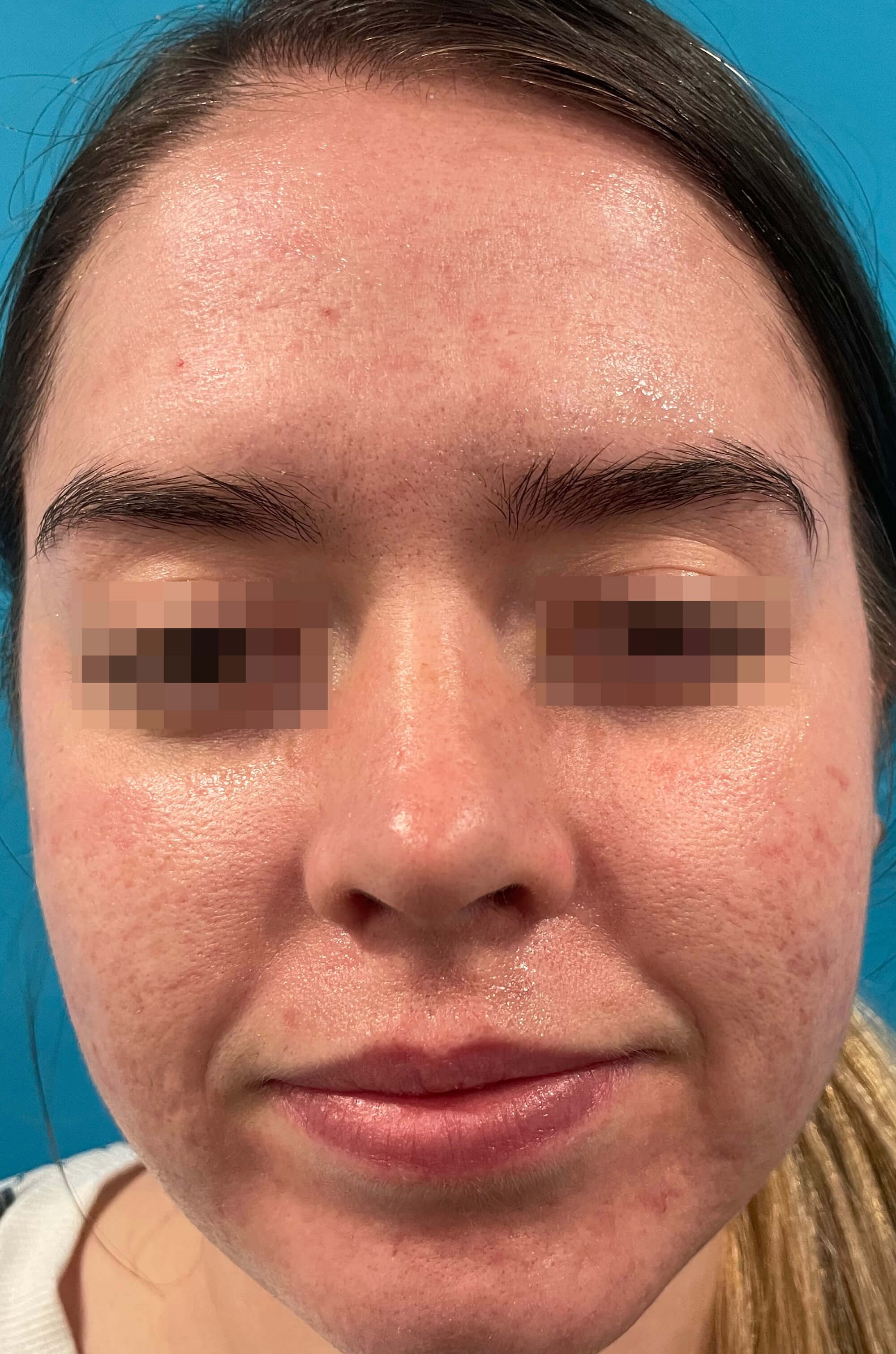 Opus Plasma Skin Resurfacing Before