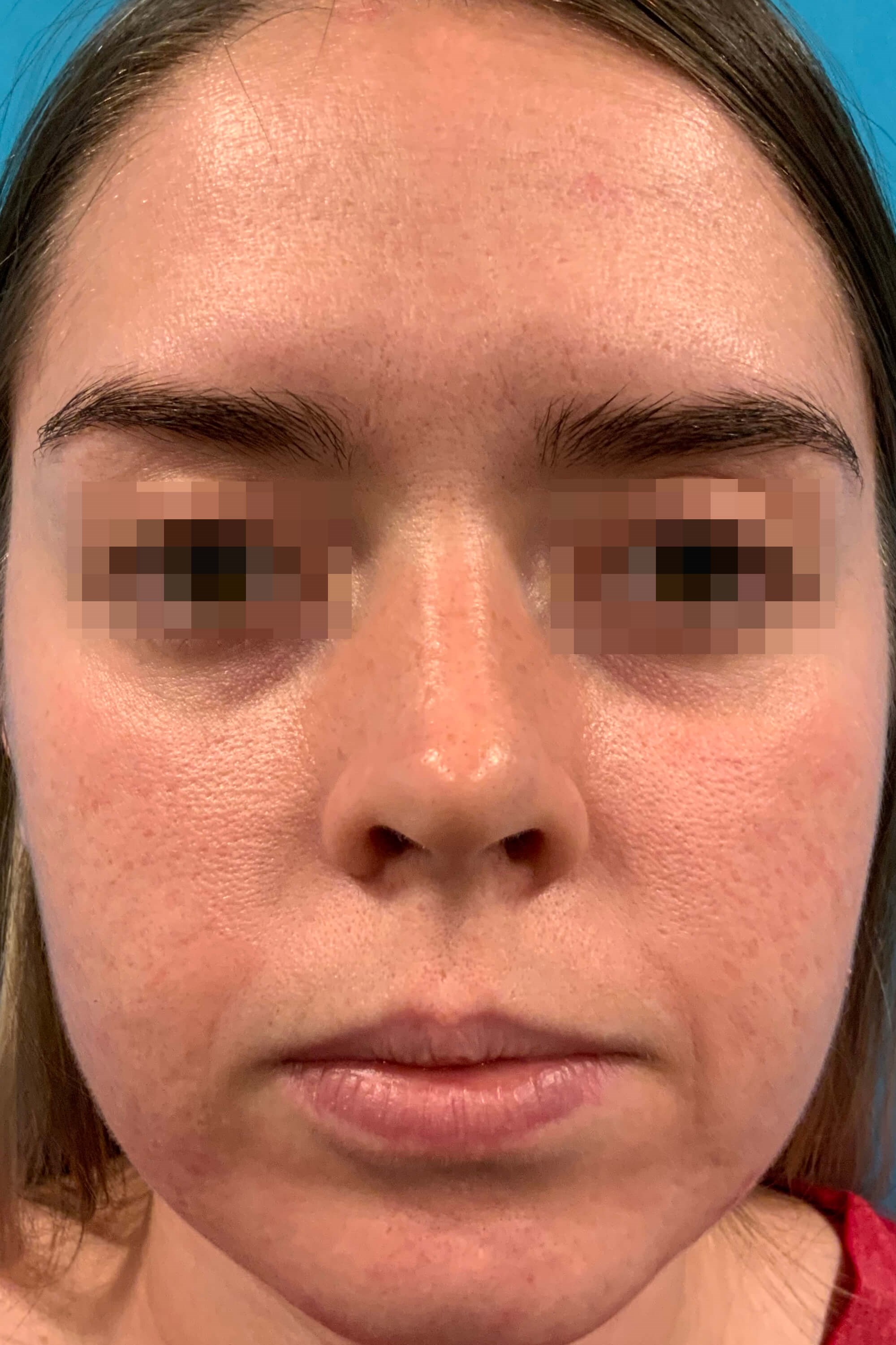 Opus Plasma Skin Resurfacing After