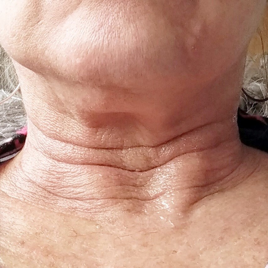 Opus Plasma Skin Resurfacing Before