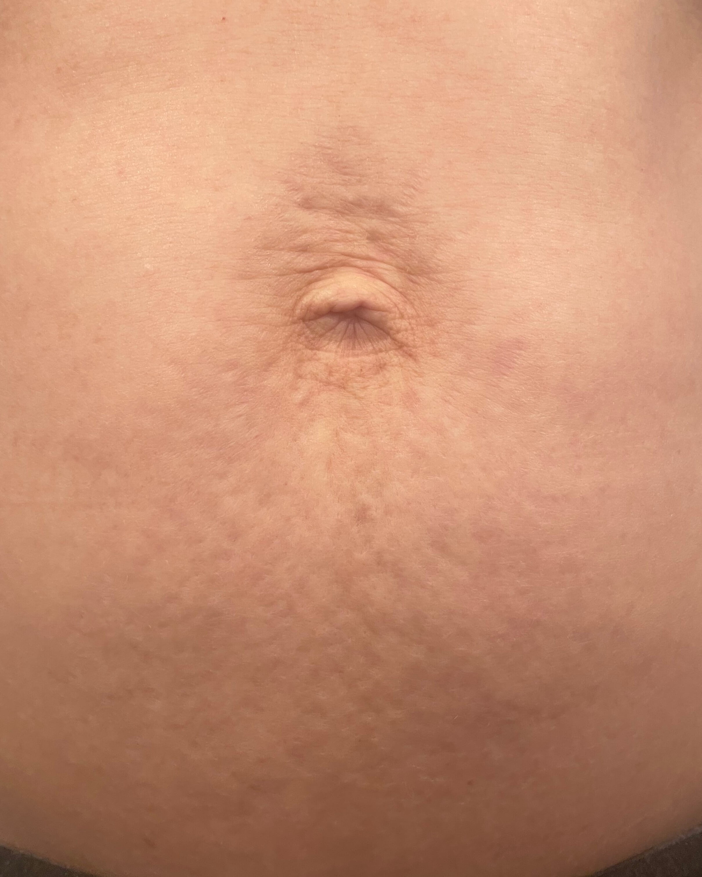 Opus Plasma Skin Resurfacing After