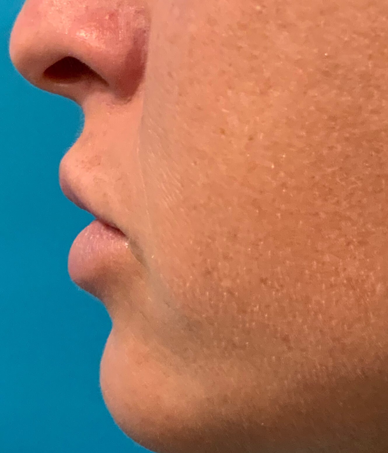 Juvederm Lip Enchancement Before