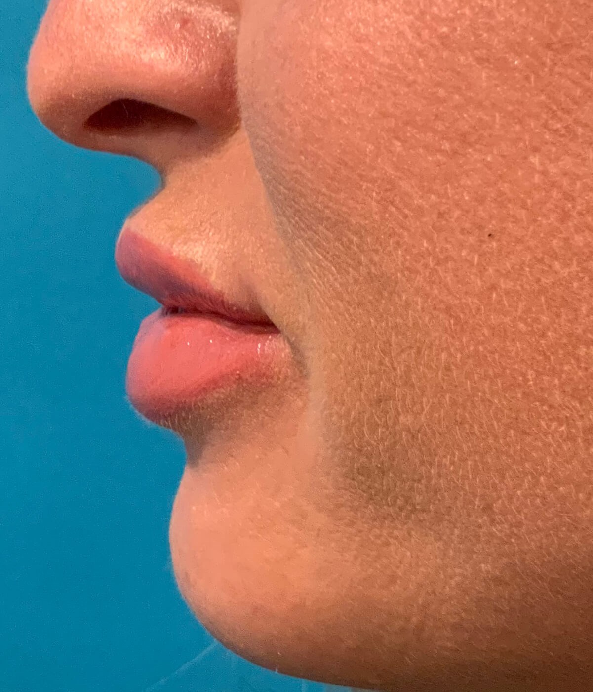 Juvederm Lip Enchancement After