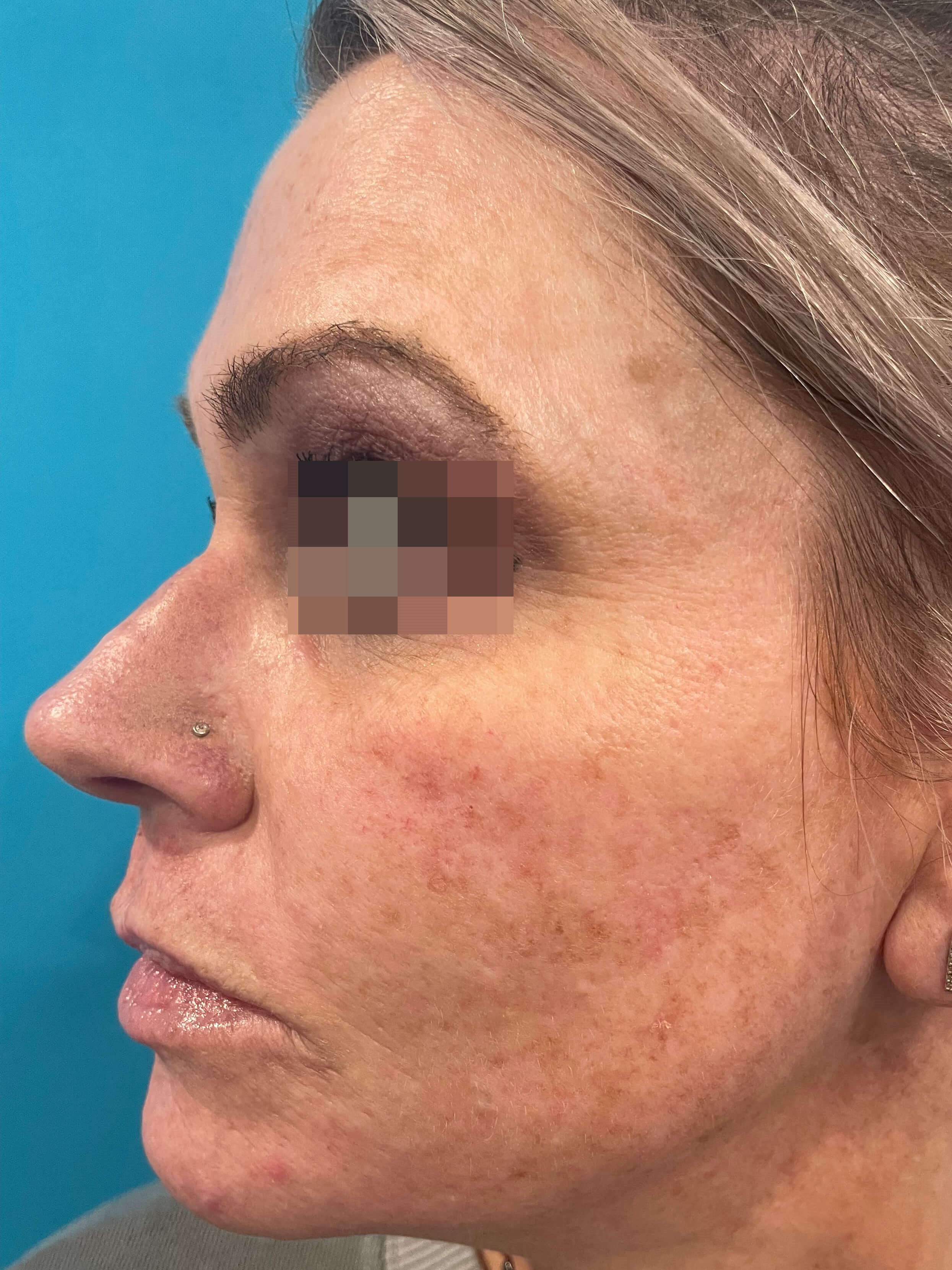 DyeVL Facial Treatment Before