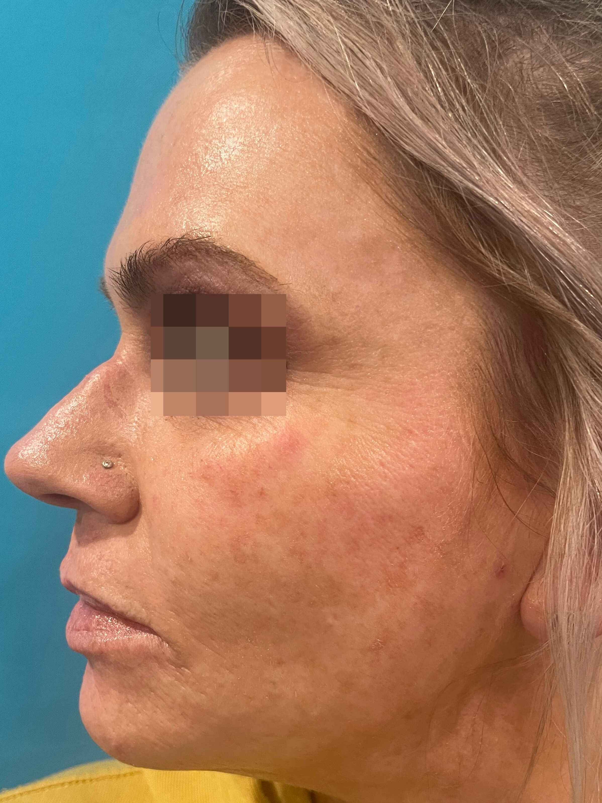 DyeVL Facial Treatment After