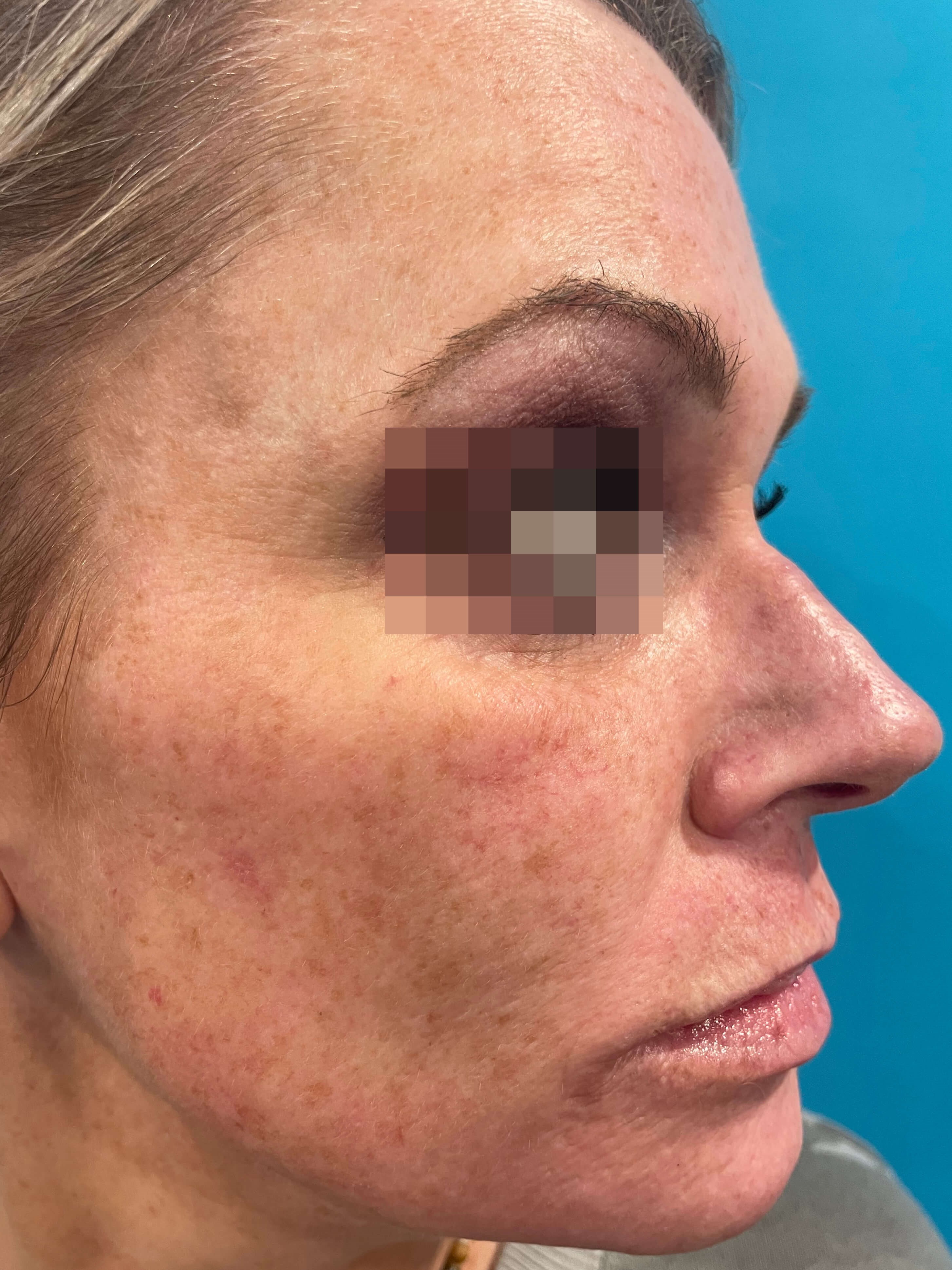 DyeVL Facial Treatment Before