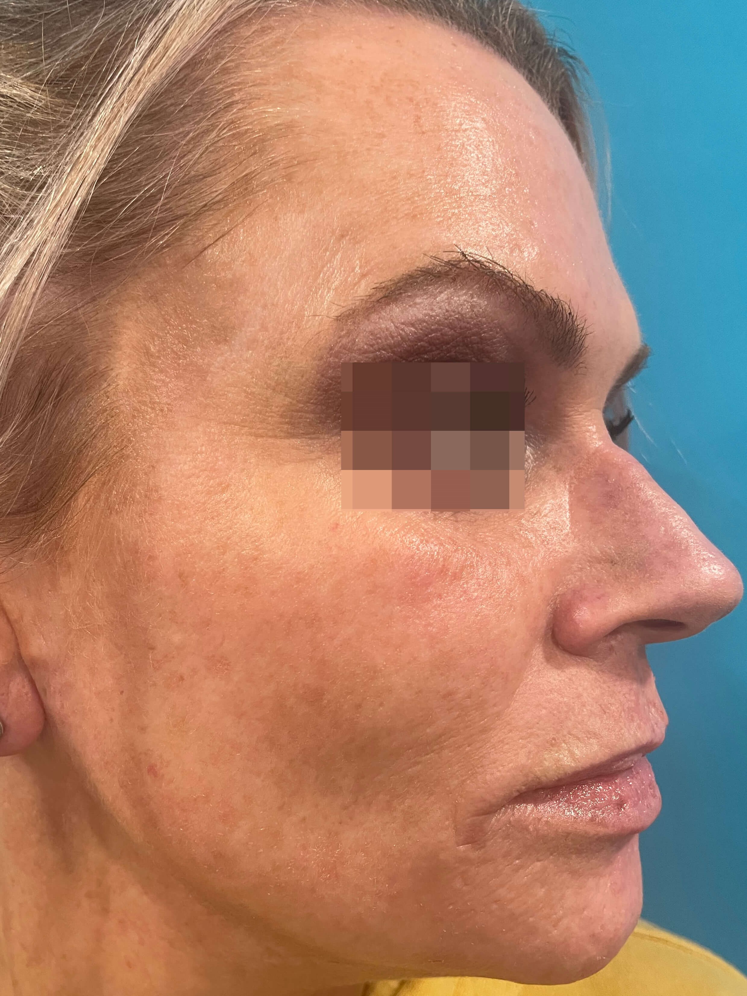 DyeVL Facial Treatment After