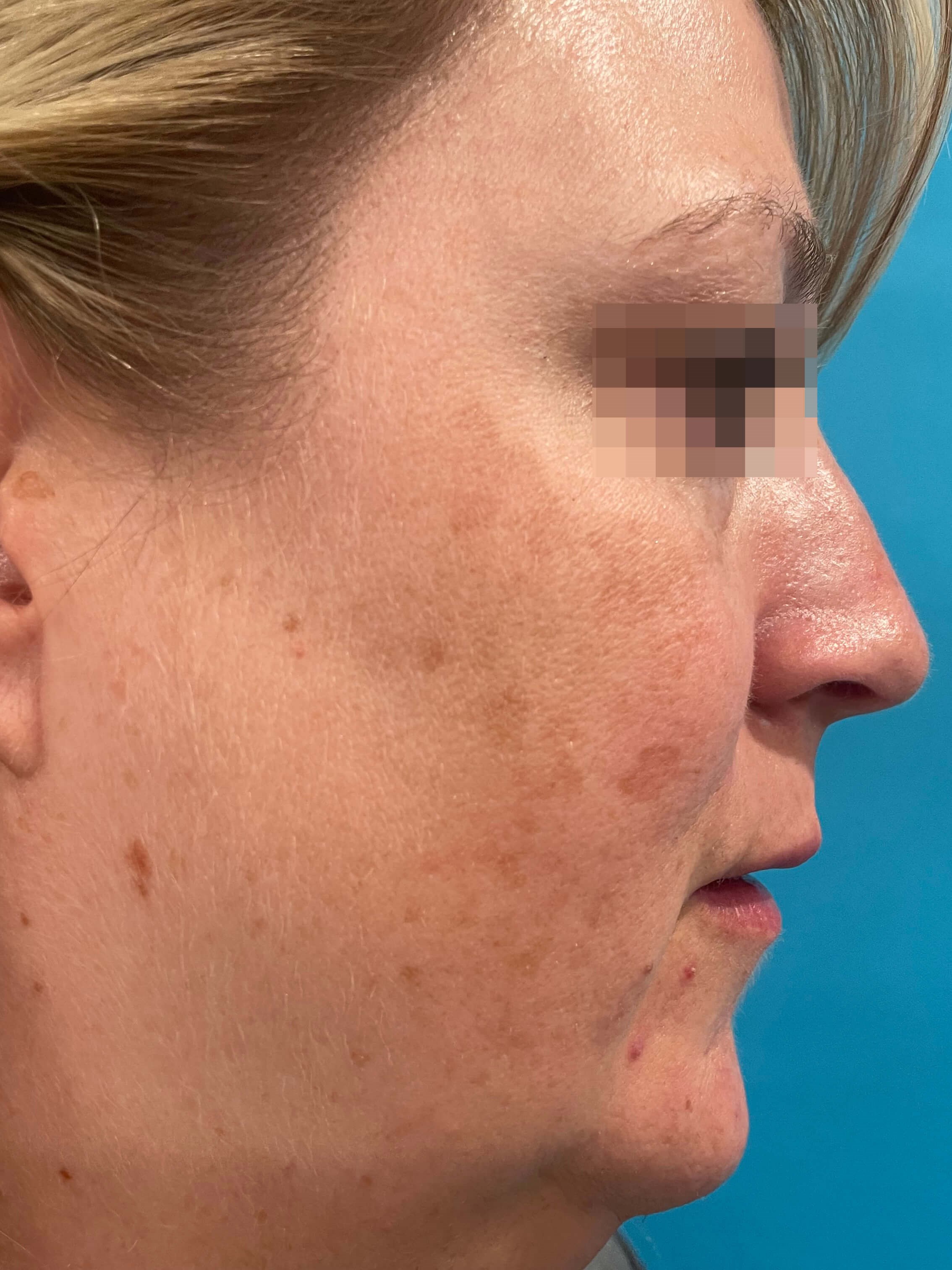 DyeVL Facial Treatment Before