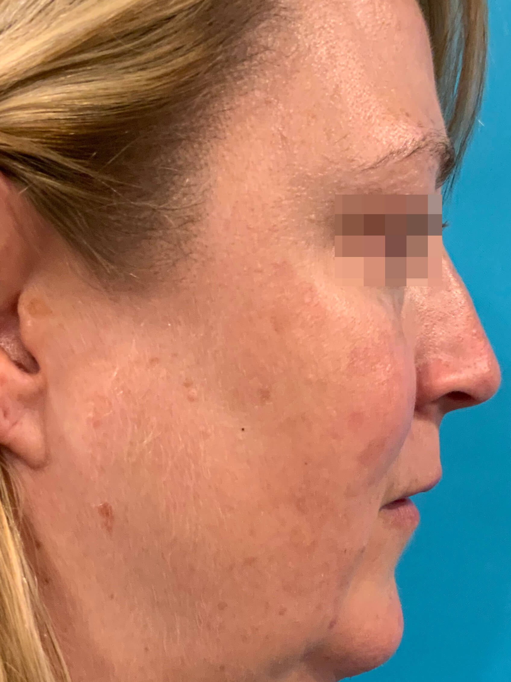DyeVL Facial Treatment After