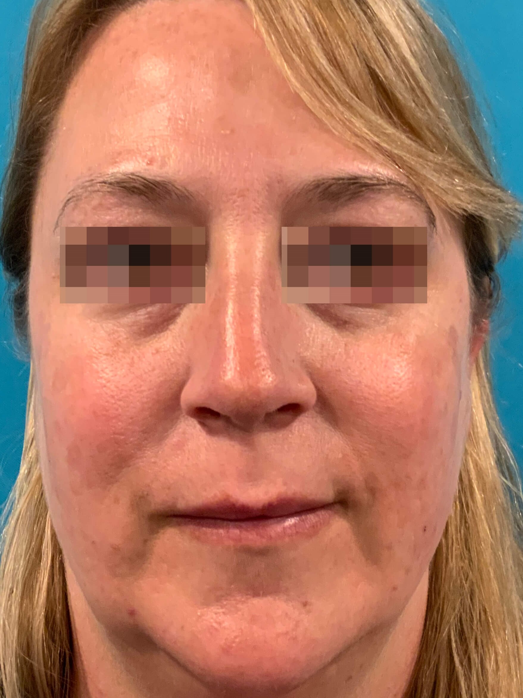 DyeVL Laser Facial Treatment After