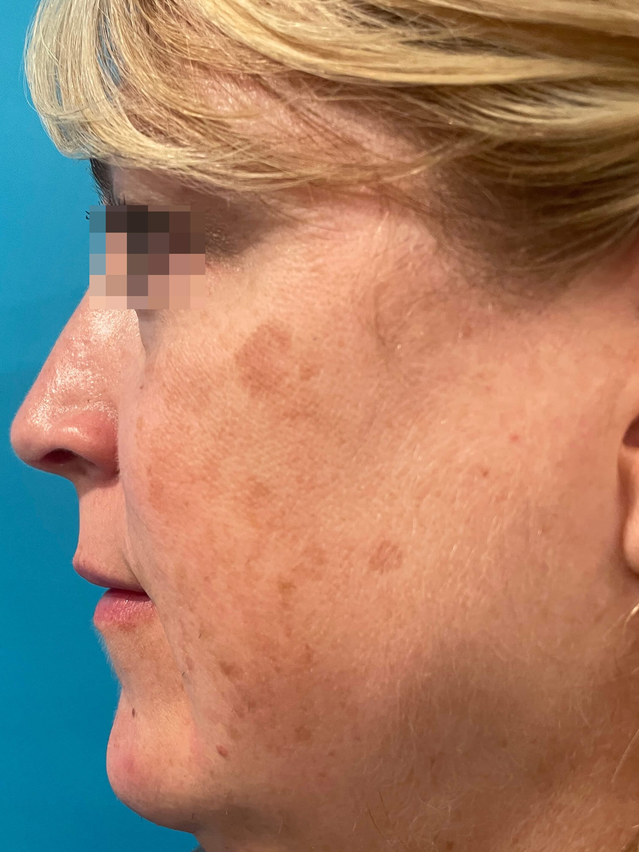 DyeVL Facial Treatment Before