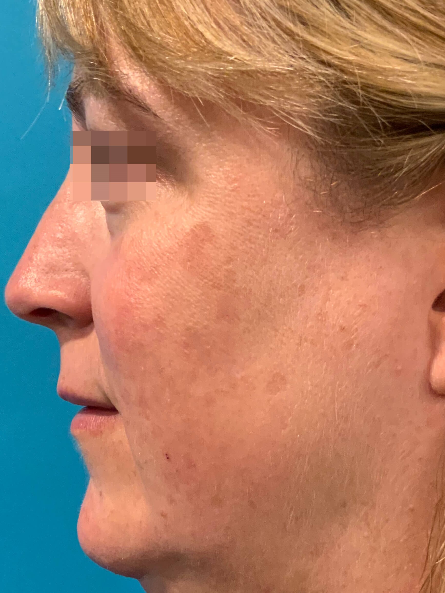 DyeVL Facial Treatment After