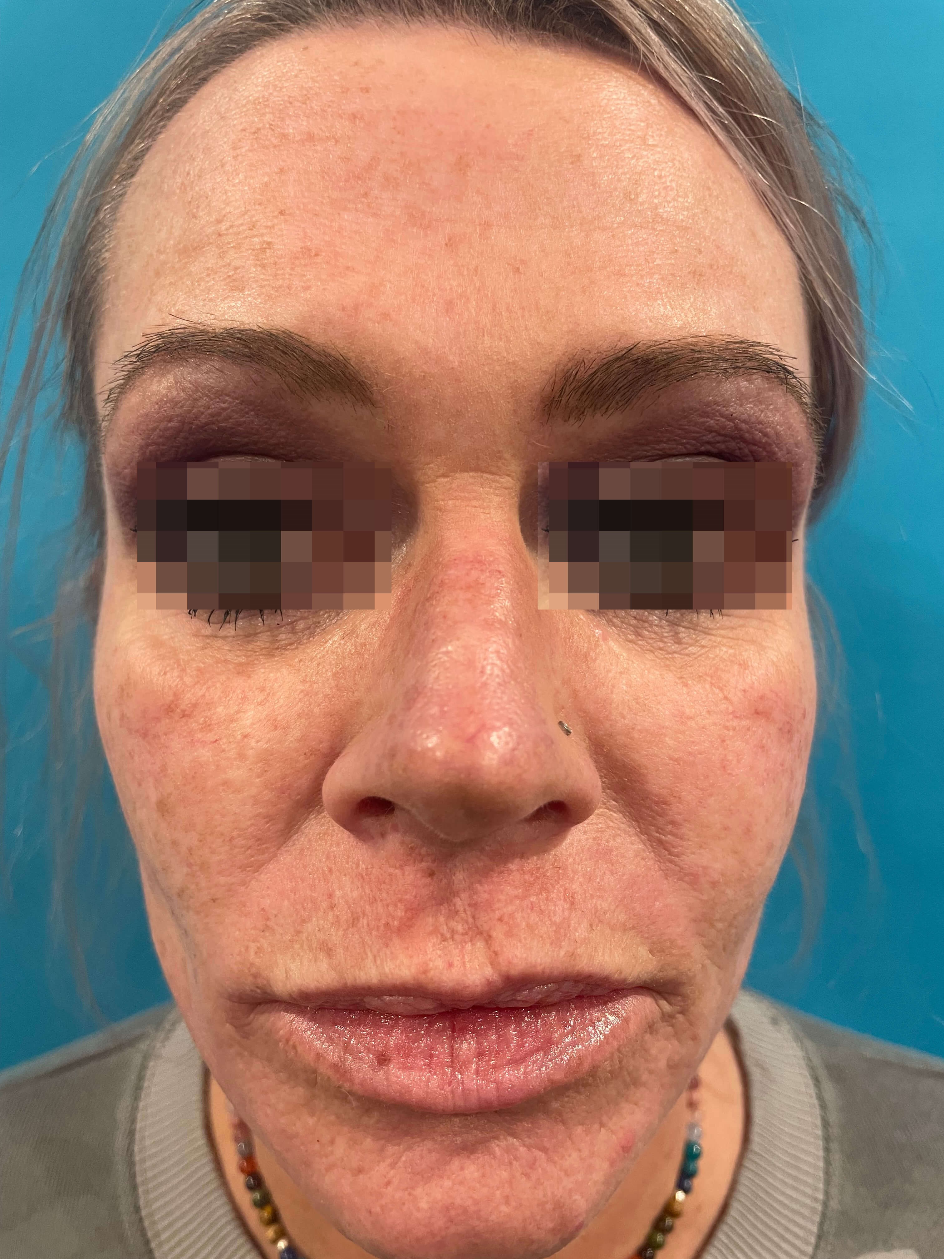 Skin Resurfacing Face Before