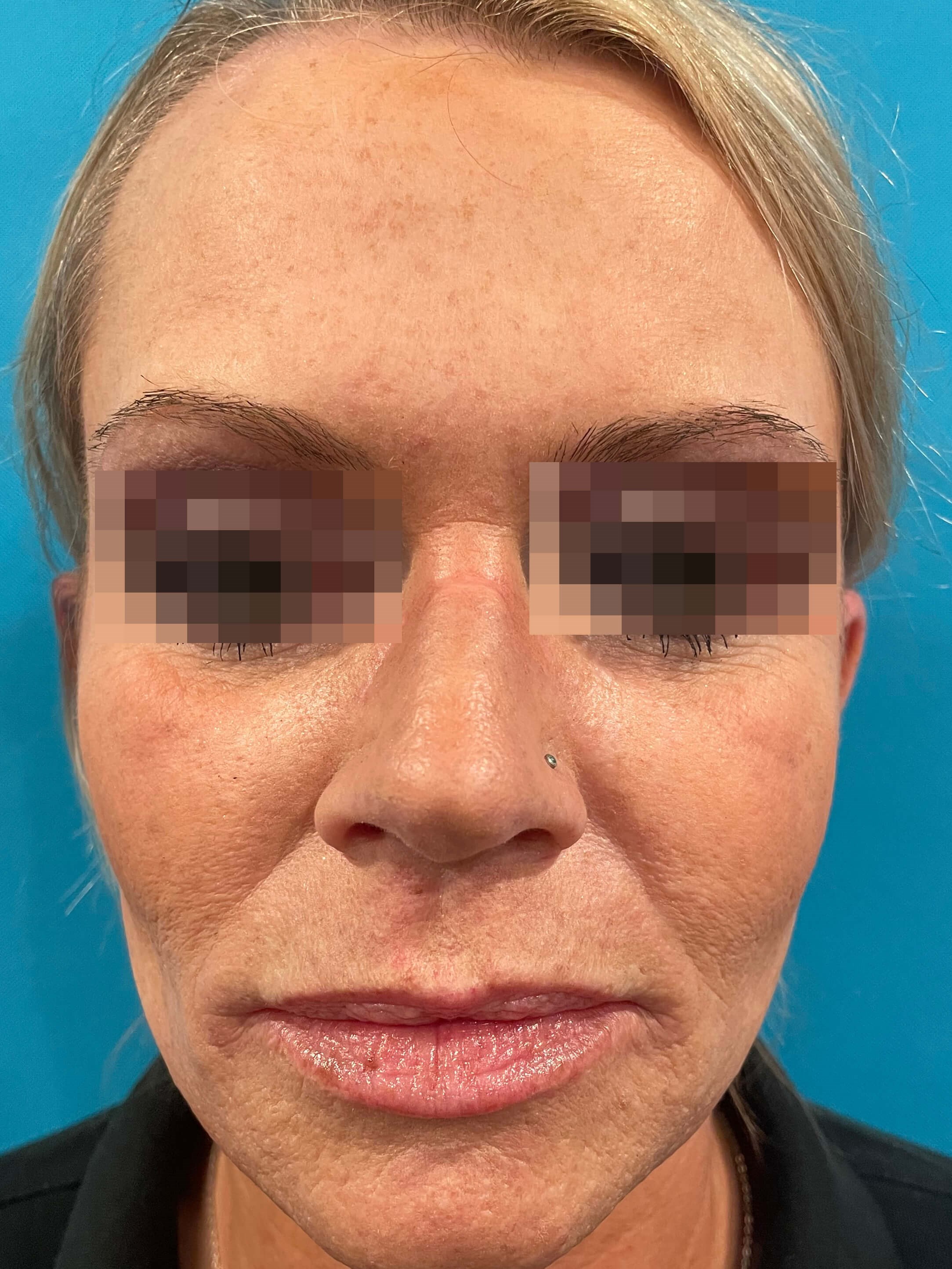 Skin Resurfacing Face After