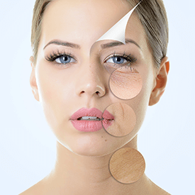 Laser Melasma Treatment